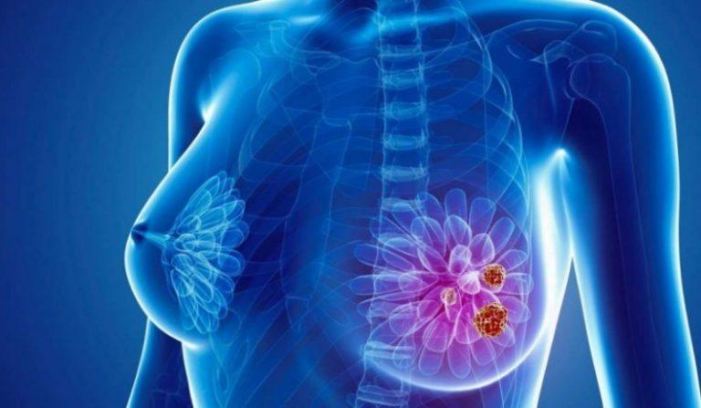 Kwara Govt flag off free cancer screening