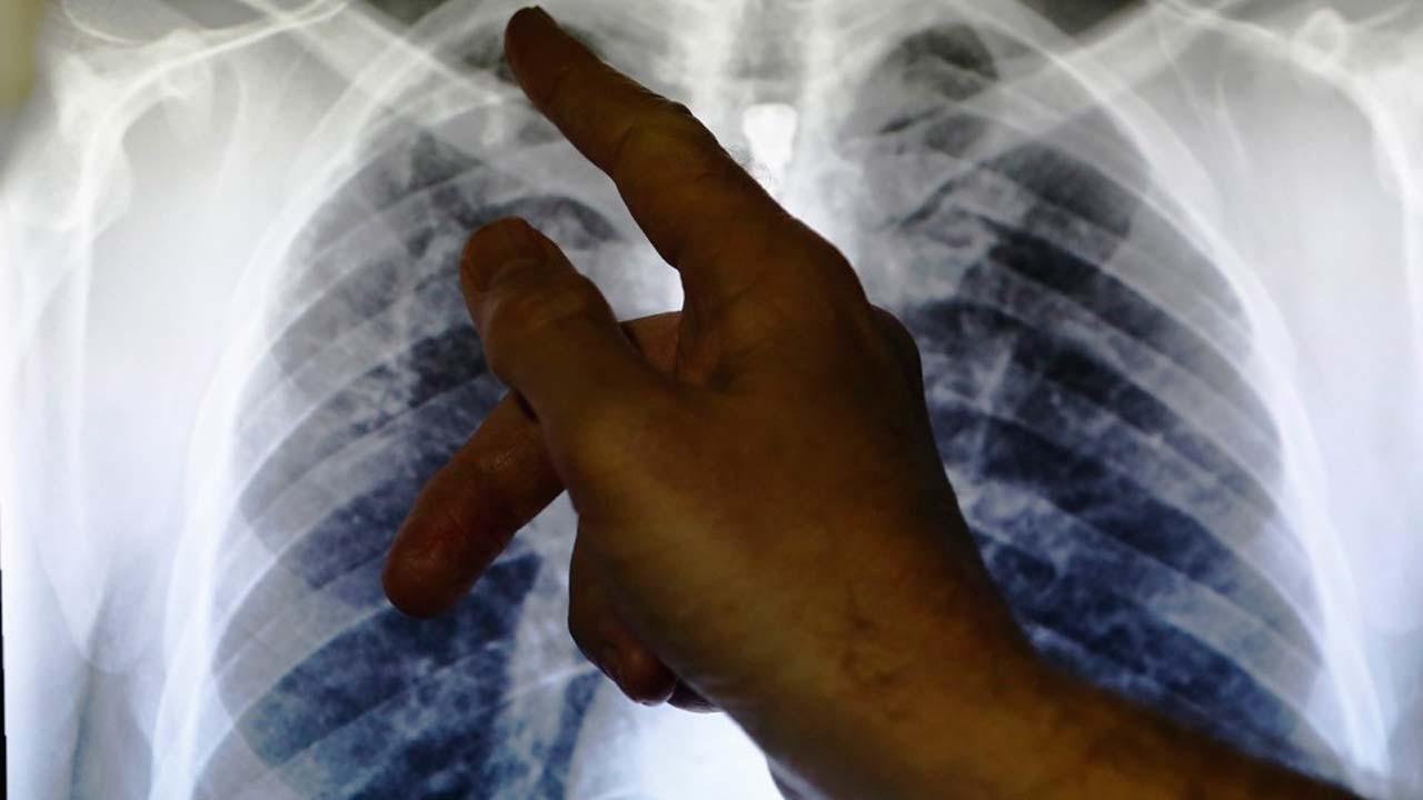 Sokoto govt to conduct house-to-house searches for suspected TB cases The Informant247