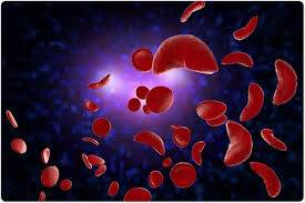 Sickle Cell: Commissioner urges intending couples to test before marriage The Informant247