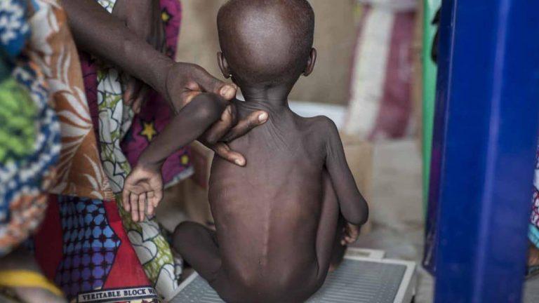 acute malnutrition in children